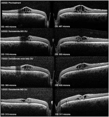 Carbonic anhydrase inhibitors limit complications in X-linked <mark class="highlighted">retinoschisis</mark>